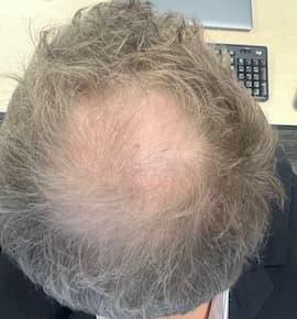man before hair loss treatment with thinning at the crown