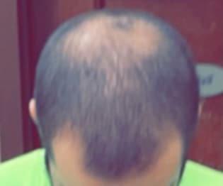 man before hair loss treatment with receding hairline