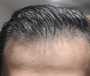 man before hair loss treatment with thinning hairline