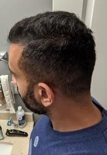 man using hair loss medication showing improved hairline