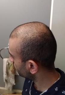 man before hair loss treatment with receding hairline