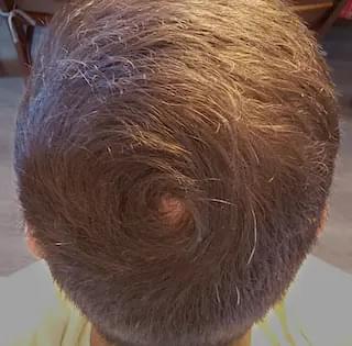 man using hair loss medication showing reduced hair loss